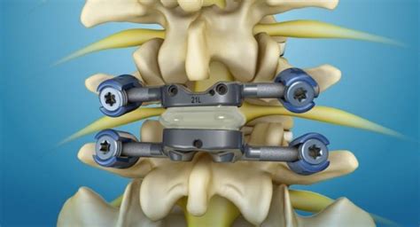 Spinal Implants And Surgery Devices Market To Witness