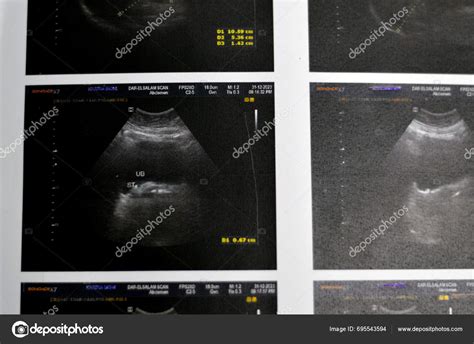 Cairo Egypt January Pelvi Abdominal Ultrasongraphy Reveals Right