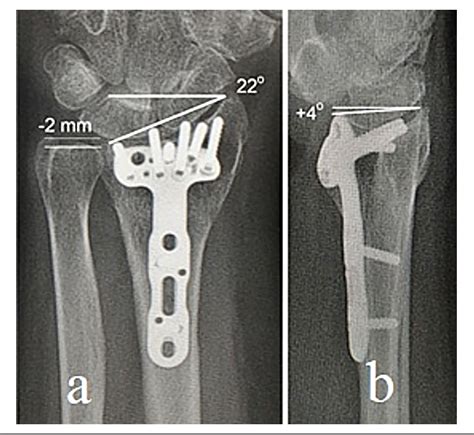 Figure 1 From Corrective Osteotomy Of Malunited Fractures Of The Distal