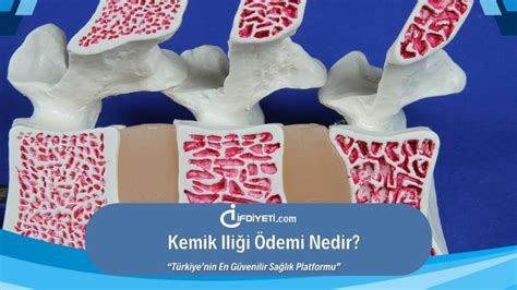 Kemik Iliği Ödemi Nedir İFDİYETİ