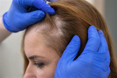 Alopécie définition causes et solution face à la perte de cheveux