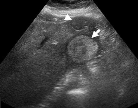 Imaging focal nodular hyperplasia | Applied Radiology