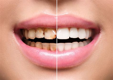 Faccette Dentali Per Migliorare L Estetica Del Sorriso