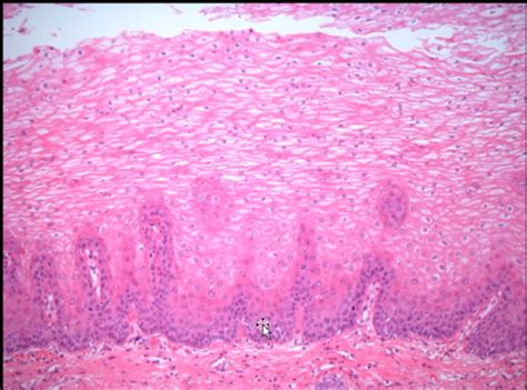 Upper Gi Pathology Flashcards Quizlet