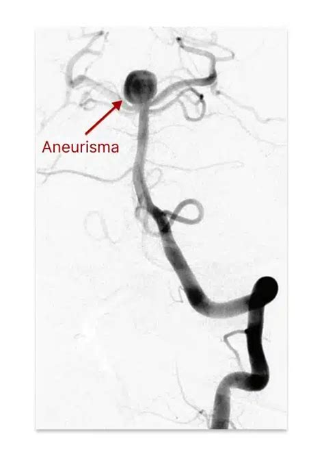 Aneurisma Cerebral Roto E Hemorragia Subaracnoide