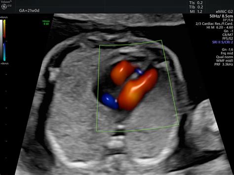 Fetal Vsd Ultrasound