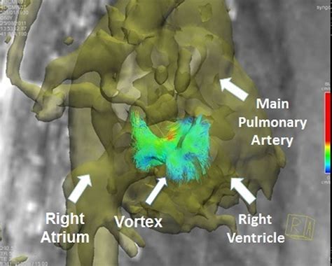 Vorticity For The Assessment Of Right Ventricular Diastolic Dysfunction