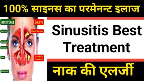 Sinusitis परमानेंट इलाज Sinusitis Treatment Sinusitis Treatment In Hindi Sinusitis