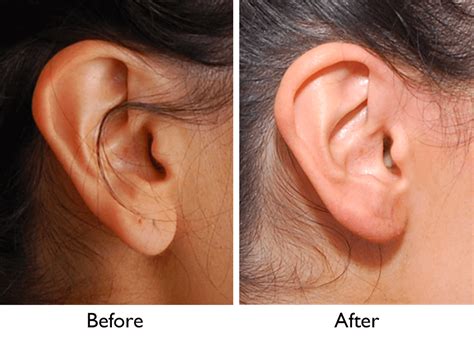 Earlobe Repair Surgery Restoring Confidence One Stitch At A Time