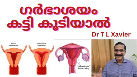 Understanding Uterine Thickening Ayurveda View Dr T L Xavier Youtube