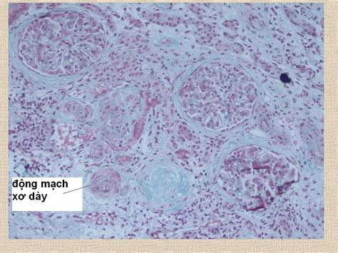 Pediatric fibromuscular dysplasia of renal arteries | PPT