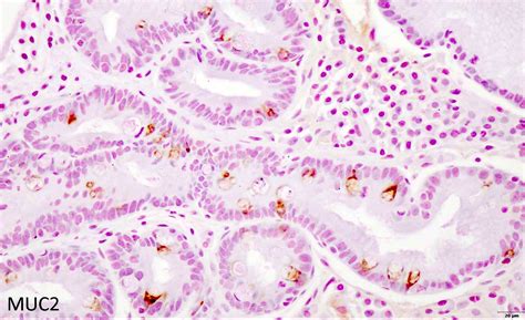 Pathology Outlines Intestinal Metaplasia