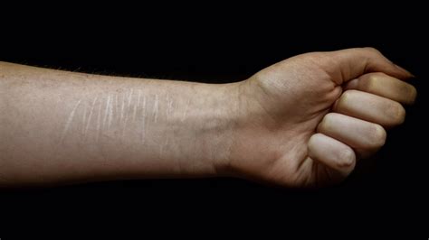 Hvordan Bli Kvitt Arr Etter Selvskading