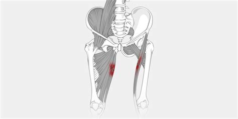 Groin Pull – The Complete Injury Guide - Vive Health