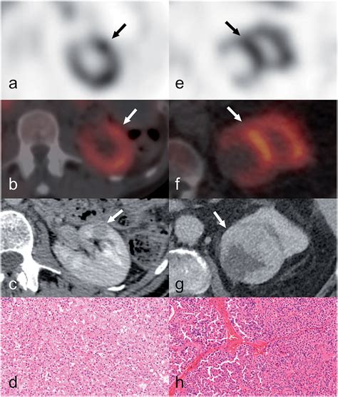 A Ro And A Hoct Both Positive On M Tc Sestamibi Spect Ct