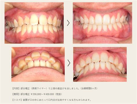 部分矯正は後戻りしやすいの？どんな理由で起こるの？｜医療法人真摯会 大阪矯正歯科グループ