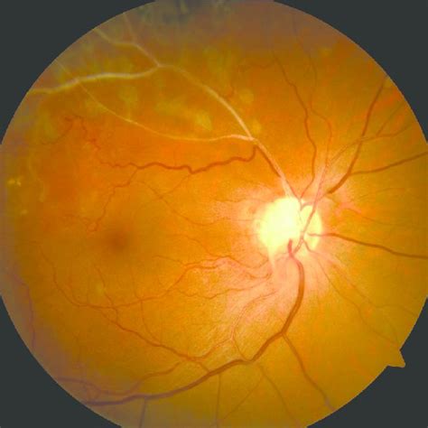 Focal Laser photocoagulation in ischemic peripheral retina in BRVO. | Download Scientific Diagram