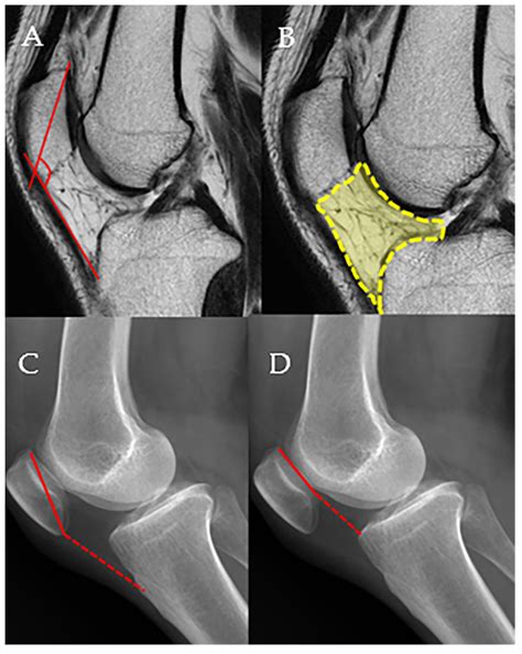 Arthroscopic Resection of Infrapatellar Fat Pad Impingement Syndrome