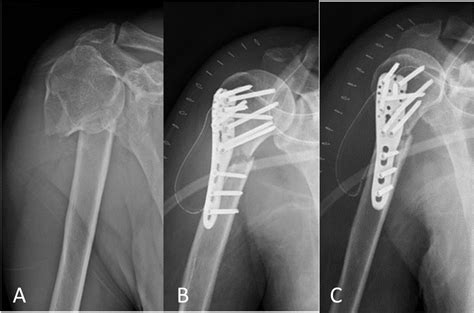 A Displaced Two Part Proximal Humeral Fracture In A 69 Year Old Male