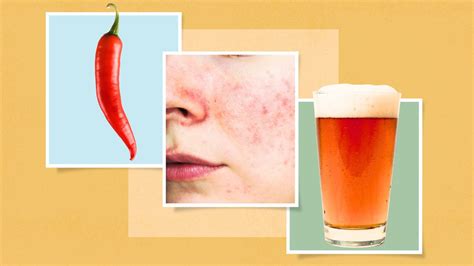 What Is Rosacea Symptoms Causes Diagnosis Treatment And Prevention