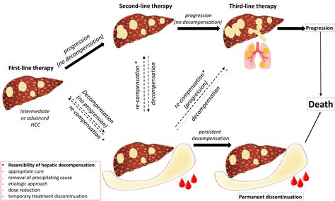 Optimizing Systemic Therapy For Advanced Hepatocellular Carcinoma The