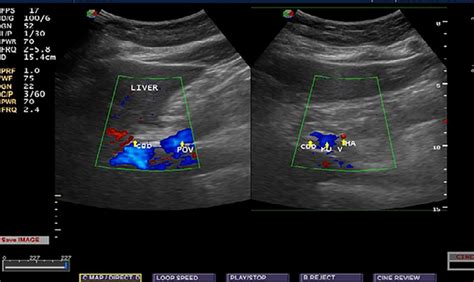 Sonographic Measurement Of Normal Common Bile Duct Diameter 50 Off