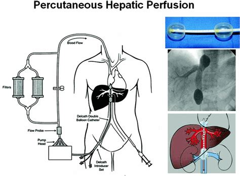 Percutaneous Hepatic Perfusion With Melphalan For Unresectable Liver