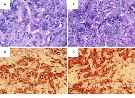 Figure 1 From Metastatic Tumor Of Male Genital System From Gastric