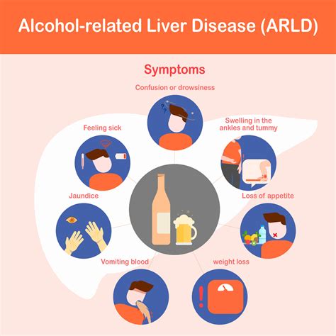 Vector Illustration Infographic Of Alcohol Related Liver Disease Or