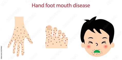 Stockvector Illustration Of Biology And Medical Hand Foot Mouth