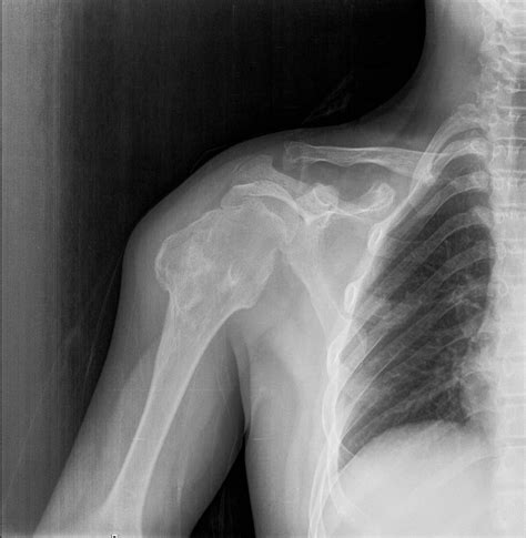 Shoulder X Ray Internal Vs External Rotation At Philip Cowell Blog