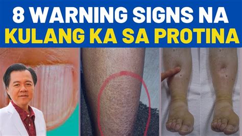 8 Warning Signs Ng Kulang Sa Protina Payo Ni Doc Willie Ong YouTube