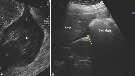 Ectopic Pregnancy Ultrasound 5 Weeks