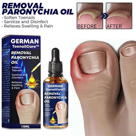 Fungal Nail Treatment Essential Oil Hand And Foot Whitening Toe Nail Fungus Removal Infection