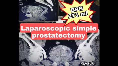 Bph 271 Ml Laparoscopic Simple Prostatectomy Millin Bph Prostate Youtube