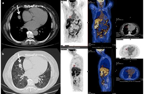 Axial A Mdct Pre Contrast Image Shows A Well Defined Nodule White