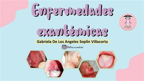 Exantemas En Pediatria Alicia En Medicina By Gabriela Soplin