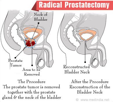 Radical Prostatectomy - Types, Tests, Procedure, Complications