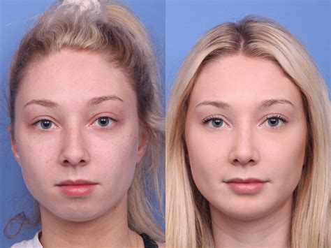 Pics Just After Rhinoplasty