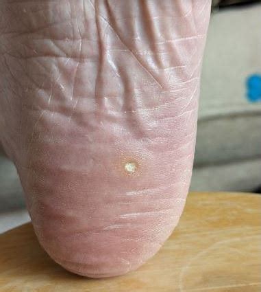 White Dot On Sole Of Foot Sale Online Emergencydentistry