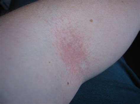 rash on inside of elbow - pictures, photos