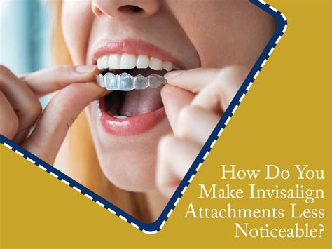 Invisalign Attachment How To Make It Less Obvious Photo 14786