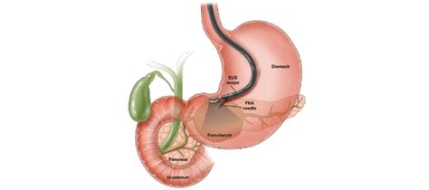 endoscopic ultrasound expert dr amit  navi mumbai