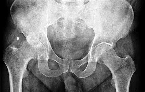 Osteoartritis De Cadera Dr Josué Calderón Gamba