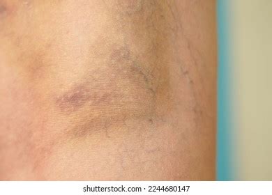 Large Hematoma On Leg Below Knee Stock Photo Shutterstock