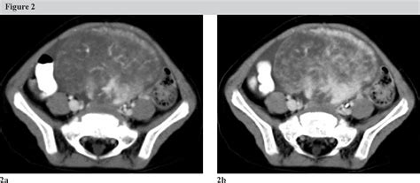 Figure 2 From Sclerosing Stromal Tumor Of The Ovary In A Three Year Old