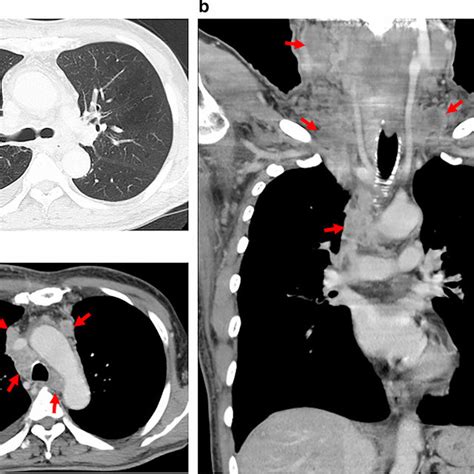 Chest Computed Tomography Findings A A Tumor In The Right Upper Lobe