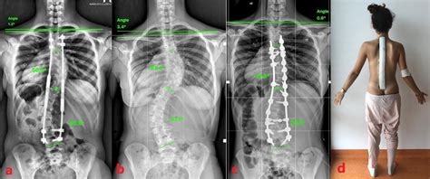 Idiopathic Early Onset Scoliosis Treated With Magec Rods What To Do