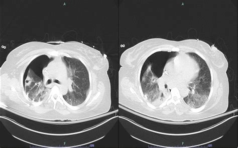 Pseudomonas Aeruginosa Infection Presenting As Microangiopathic