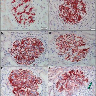 Transmission Electron Microscopy In Pediatric Lupus Nephritis Ln